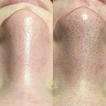 Чистка лица
                    Врач-косметолог Наталья Киев