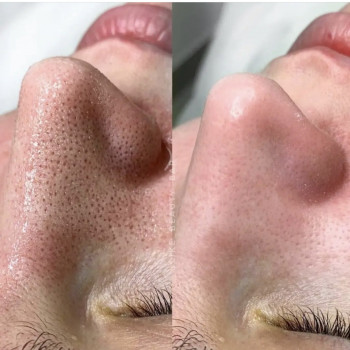 Чистка лица
                    Врач-косметолог Наталья Киев