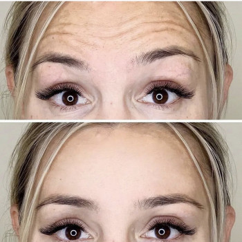 Ботулинотерапия
                    Лікар-косметолог Наталья Київ