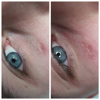 Видалення судинної сіточки