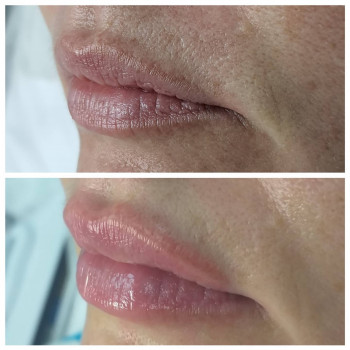 Корекція губ