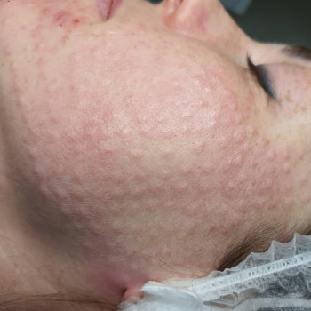 Біоревіталізація