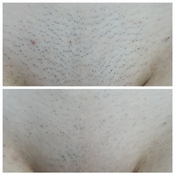 IPL епіляція