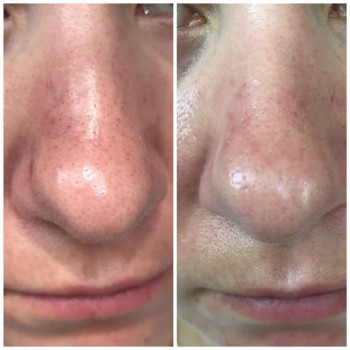 Чистка обличчя