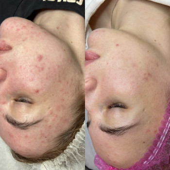 Чистка обличчя
                    Салон краси Sweet Skin Київ
