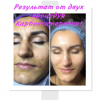 Карбокситерапия результат от 2 процедур!?