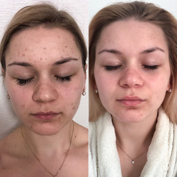 Электропорация (апаратна мезотерапия)
                    Салон краси Sweet Skin Київ