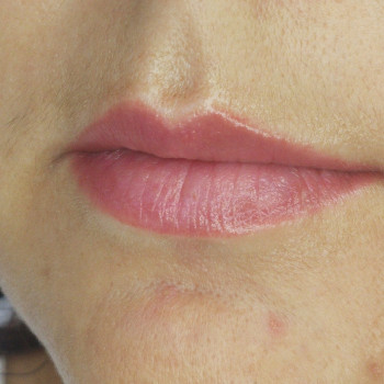 Зажившие перед коррекцией