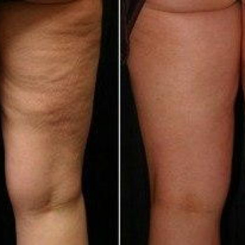 Антицелюлітний масаж (апаратний)
                    Косметологический центр Стиль Лилий Нежин