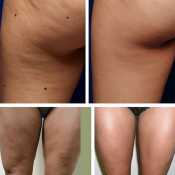 Антицелюлітний масаж (апаратний)
                    Косметологический центр Стиль Лилий Нежин