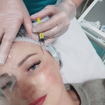 Мезотерапия,биоревитализация