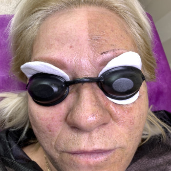 Результат сразу после первой процедуры.