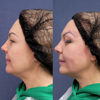 Нитевой лифтинг (Тредлифтинг)
                    Косметолог Кира Киев