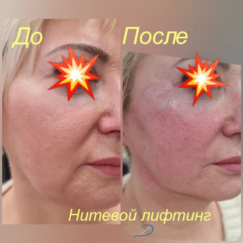 Нитевой лифтинг (Тредлифтинг)
                    Косметолог Кира Киев