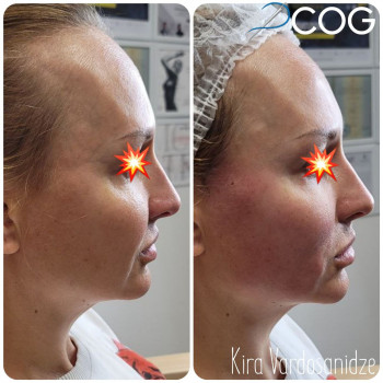 Нитевой лифтинг (Тредлифтинг)
                    Косметолог Кира Киев