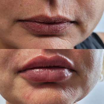 Контурная пластика
                    Косметолог Кира Київ