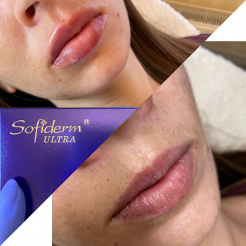 Контурная пластика
                    Косметолог Кира Київ