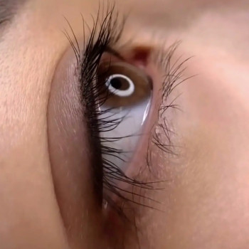 Межресничка