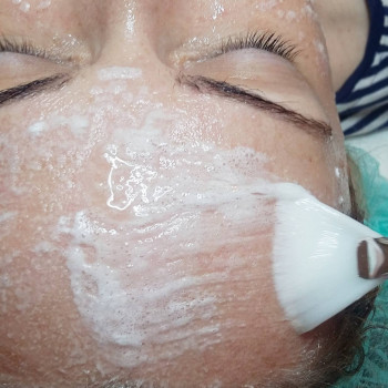 Карбоксітерапія, фото - косметолог ВикторияВікторія Моцная