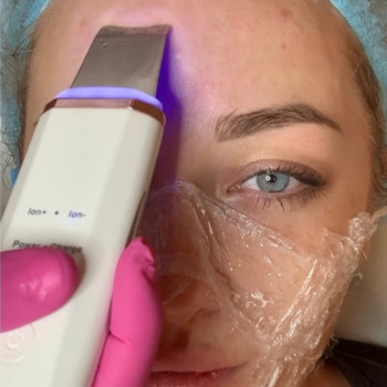 Ультрозвуковая чистка лица, фото - косметолог ВикторияВікторія Моцная