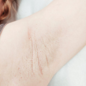 Восковая депиляция, фото - косметолог ВикторияВікторія Моцная