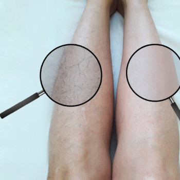 Восковая депиляция, фото - косметолог ВикторияВікторія Моцная