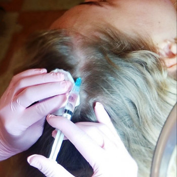 Мезотерапия кожи головы, фото - косметолог ВикторияВікторія Моцная