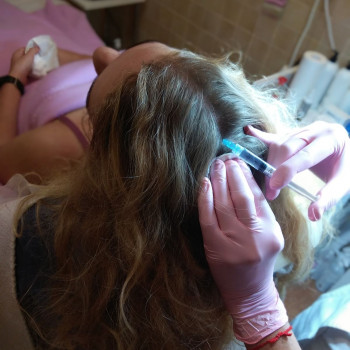 Мезотерапия кожи головы, фото - косметолог ВикторияВікторія Моцная