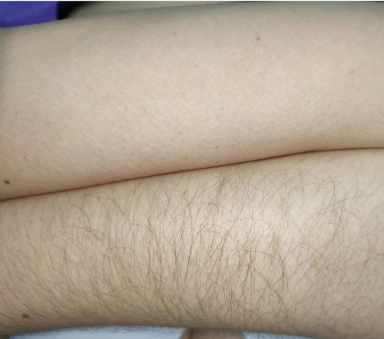 Шугаринг рук, фото - Мастер депиляции Юлия Нужнач