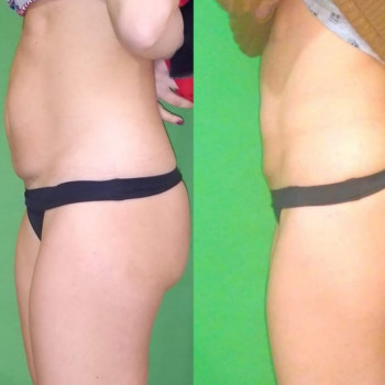 Ручная Пластика. (Армопластика) Живот
                    Массажист Вячеслав Одесса