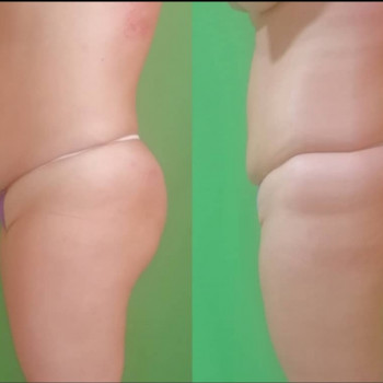 Ручная Пластика. (Армопластика) Живот
                    Массажист Вячеслав Одесса