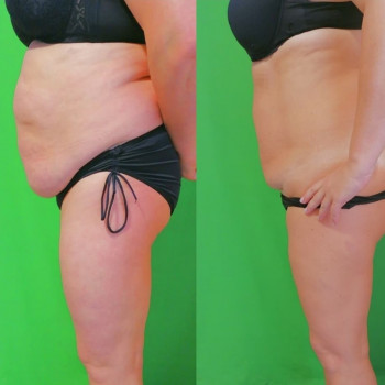 Ручная Пластика. (Армопластика) Живот
                    Массажист Вячеслав Одесса