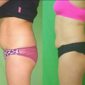 Ручная Пластика. (Армопластика) Живот
                    Массажист Вячеслав Одесса