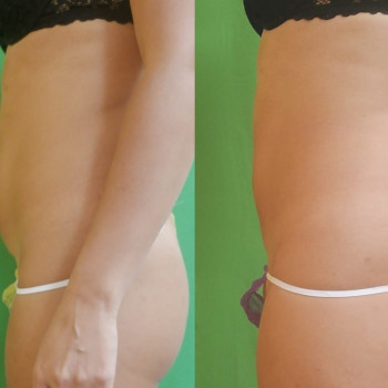 Ручная Пластика. (Армопластика) Живот
                    Массажист Вячеслав Одесса