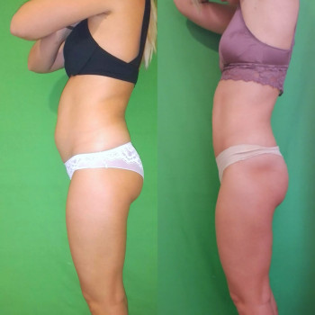 Ручная Пластика. (Армопластика) Живот
                    Массажист Вячеслав Одесса