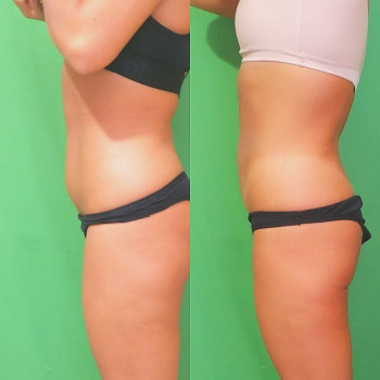 Ручная Пластика. (Армопластика) Живот
                    Массажист Вячеслав Одесса