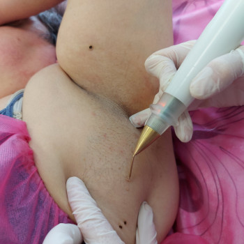 Лазерне видалення в ділянці пахв.