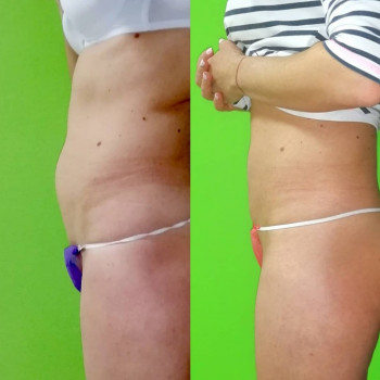 Ручная Пластика. (Армопластика) Живот
                    Массажист Вячеслав Одесса