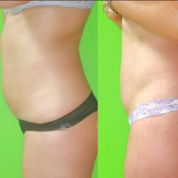 Ручная Пластика. (Армопластика) Живот
                    Массажист Вячеслав Одесса