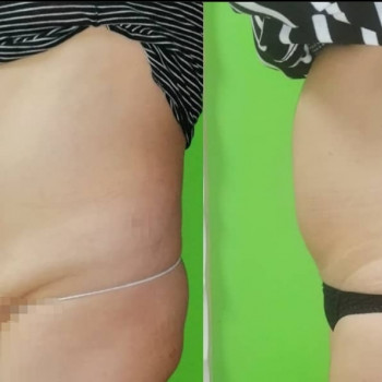 Ручная Пластика. (Армопластика) Живот
                    Массажист Вячеслав Одесса