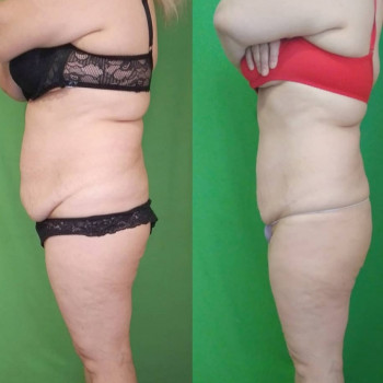 Ручная Пластика. (Армопластика) Живот
                    Массажист Вячеслав Одесса