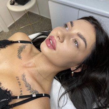 Увеличение губ / контурная пластика губ
                    Косметолог-инъекционист Анастасия Киев