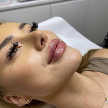 Увеличение губ / контурная пластика губ
                    Косметолог-инъекционист Анастасия Киев