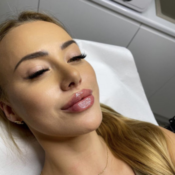 Увеличение губ / контурная пластика губ
                    Косметолог-инъекционист Анастасия Киев