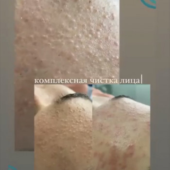 Комплексная чистка лица
                    Дерматолог косметолог Анна Одеса