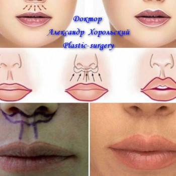 Булхорн пластика.
Хейлопластика.