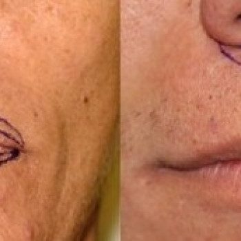 ДО       ПОСЛЕ
Хейлопластика.