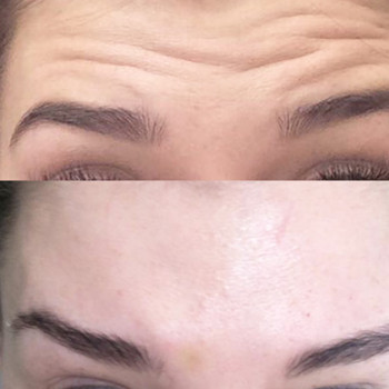 Ботокс/ ботулинотерапия
                    Косметолог Анастасия Одесса