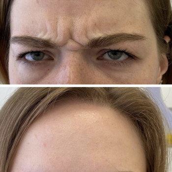 Ботокс/ ботулинотерапия
                    Косметолог Анастасия Одесса