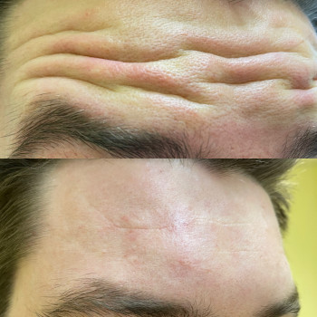 Ботокс/ ботулинотерапия
                    Косметолог Анастасия Одесса